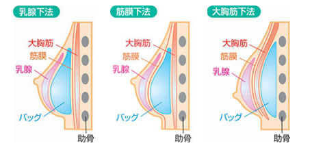 豊胸のアプローチ法