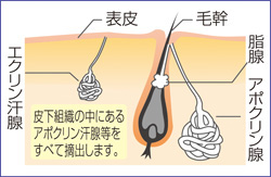 ワキガ・わきが・多汗症のメカニズム