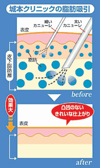 城本クリニックの脂肪吸引
