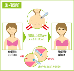 脂肪注入法 施術図解