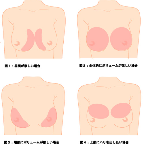 ヒアルロン酸豊胸によるプチ豊胸手術
